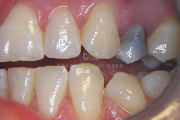 Wibielanie przebarwionego zęba po leczeniu kanałowym - Przed