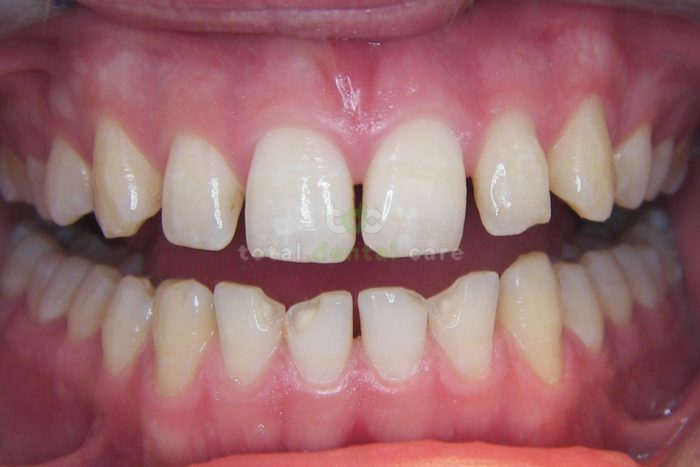 Non-invasive reconstruction of lower front teeth - Before