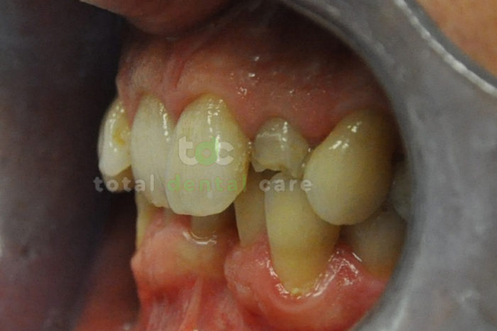 Odbudowa złamanego zęba pełnoceramiczną koroną - Przed
