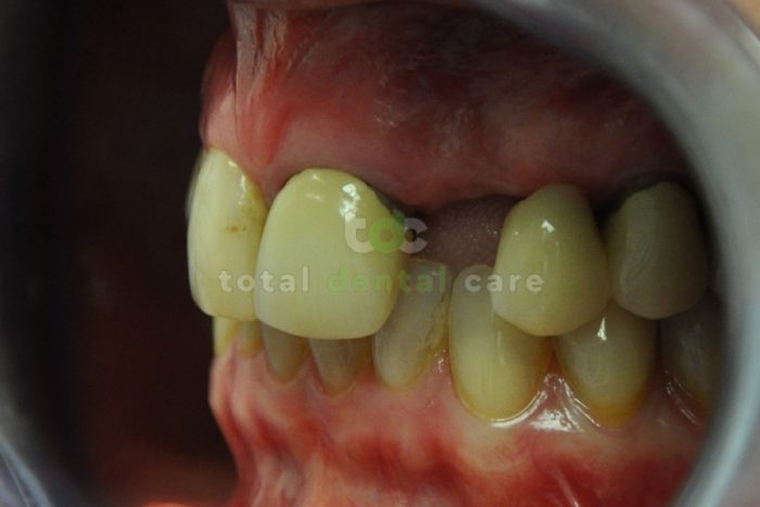 Upper arch reconstruction with a metal free dental bridge - Before
