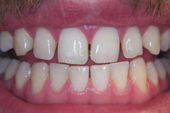 Non-invasive reconstruction of lower front teeth