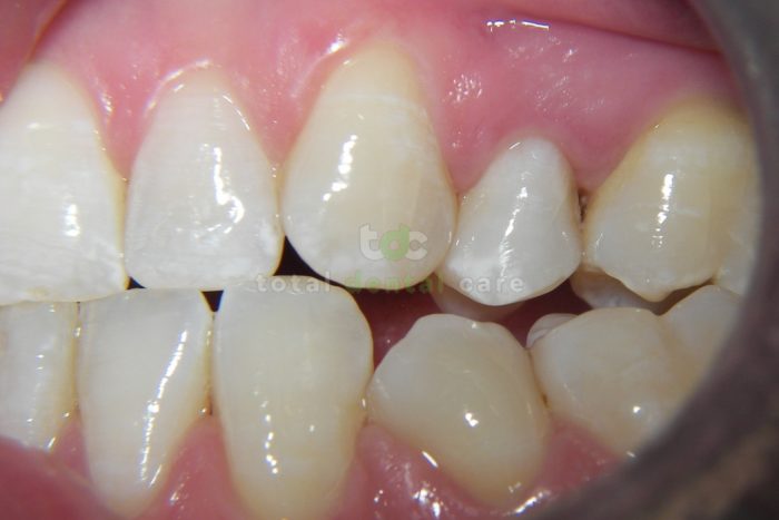 Wibielanie przebarwionego zęba po leczeniu kanałowym - Po