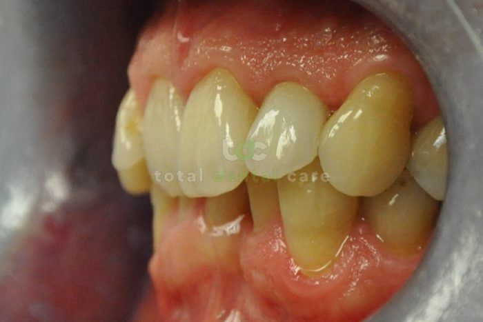 Odbudowa złamanego zęba pełnoceramiczną koroną - Po