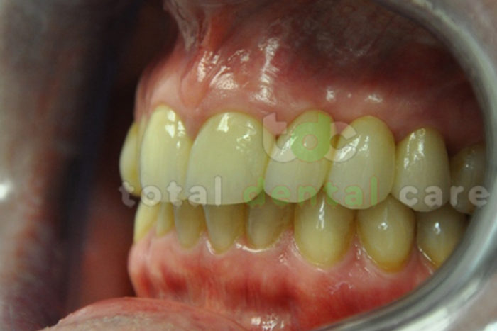 Upper arch reconstruction with a metal free dental bridge