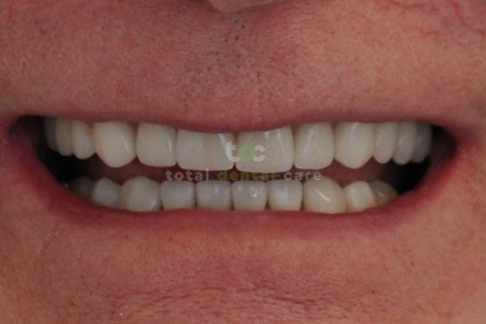 Pełna rekonstrukcja górnego i dolnego łuku zębowego