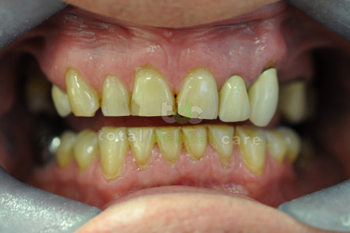 Pełna rekonstrukcja górnego i dolnego łuku zębowego - Przed